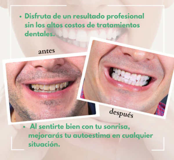 Facetas Dentales™ Sonrisa Perfecta